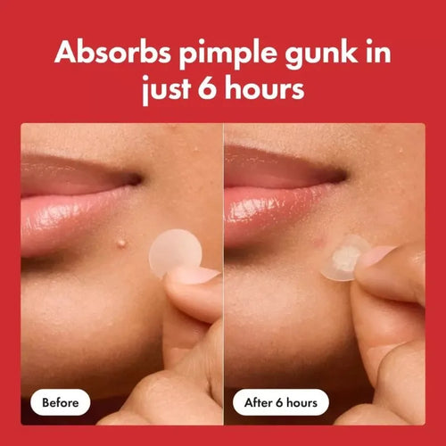 Mighty Patch Pimple Fix